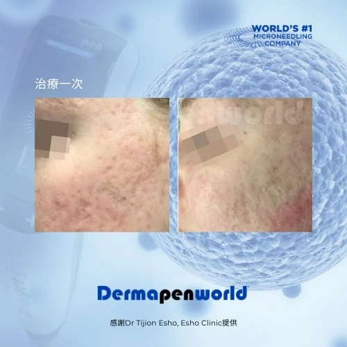 得美微案例前後_凹洞疤肌膚