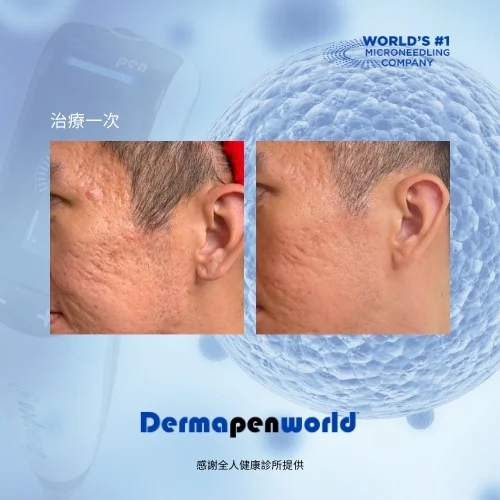 得美微案例前後_凹洞疤肌膚