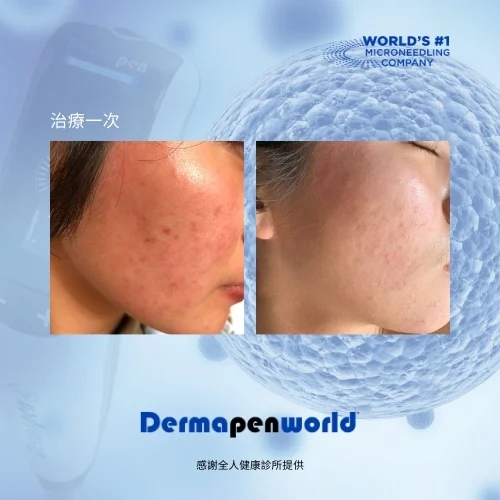 得美微案例前後_凹洞疤肌膚