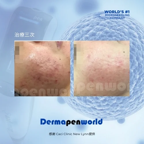 得美微案例前後_凹洞疤肌膚