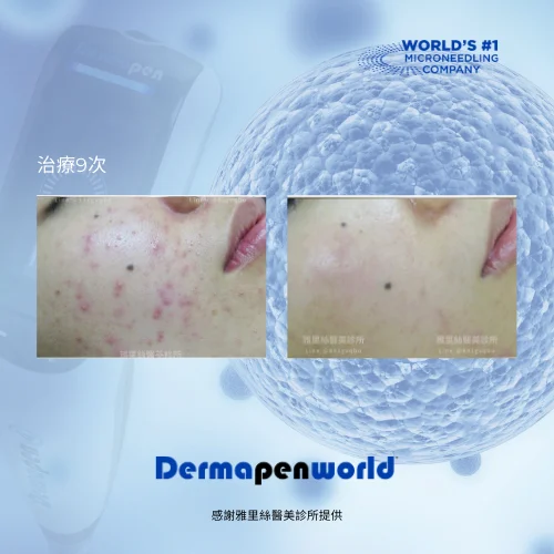 得美微案例前後_凹洞疤肌膚