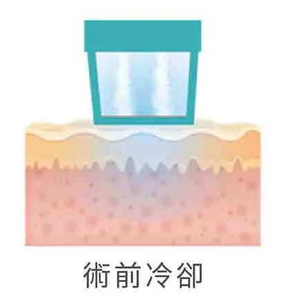 Oligio X 超玩美電波-冷卻模式-術前冷卻