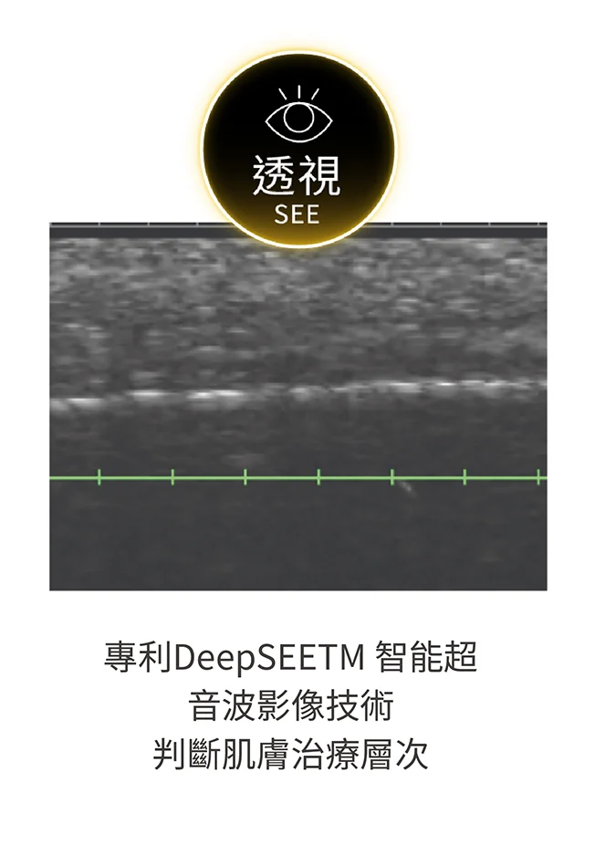 美國音波2.0-獨家黃金標準療程1