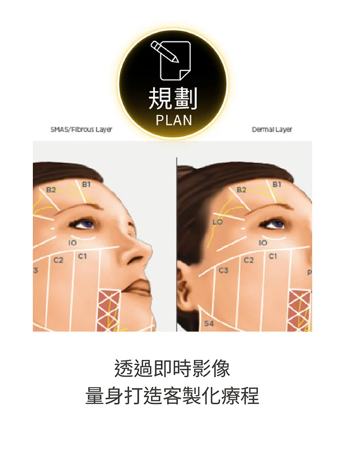 美國音波2.0-獨家黃金標準療程2