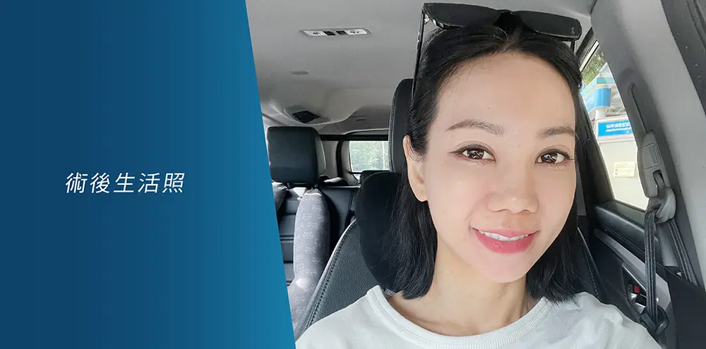 Ultherapy 美國音波案例分享：治療前後對比