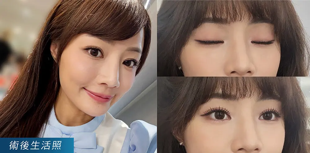 超玩美電波_眼周緊緻 案例
