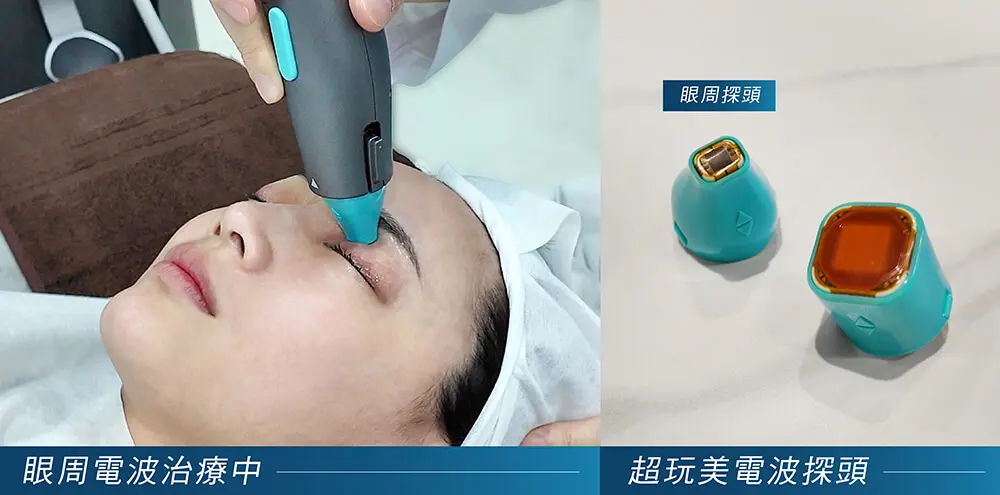 超玩美電波_眼周拉提案例施打過程與探頭差別