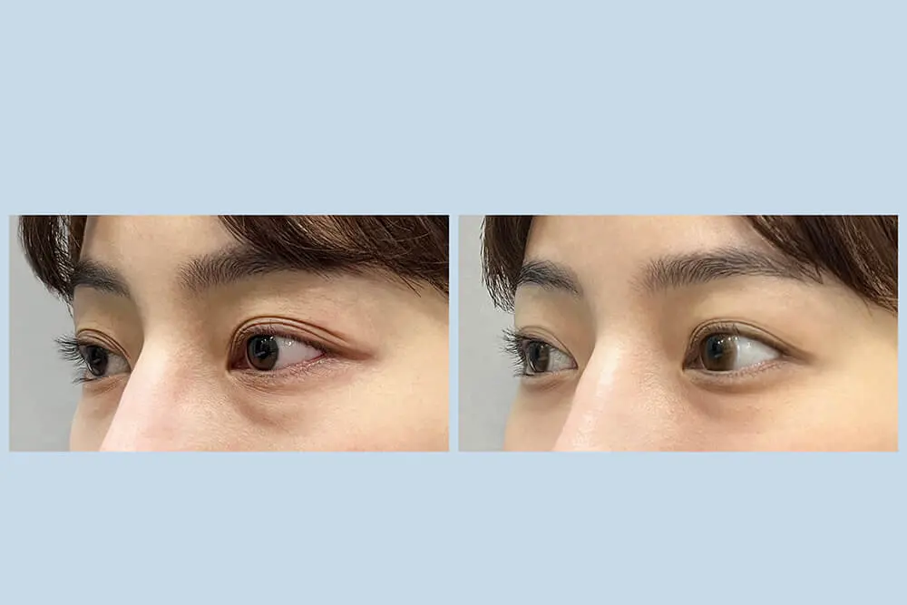 超玩美眼周電波_案例分享_側邊特寫