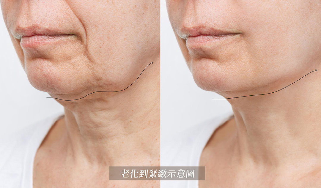 電音波能量深入真皮層與脂肪層，達到拉提與緊緻效果