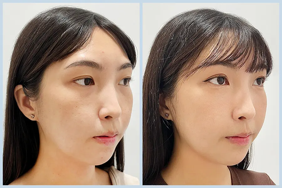 膠原流失型黑眼圈改善案例,透過膠原增生療程提升眼周支撐與明亮感