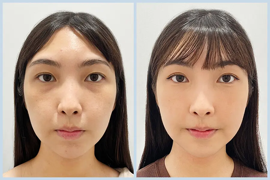 膠原流失型黑眼圈改善案例,透過膠原增生療程提升眼周支撐與明亮感