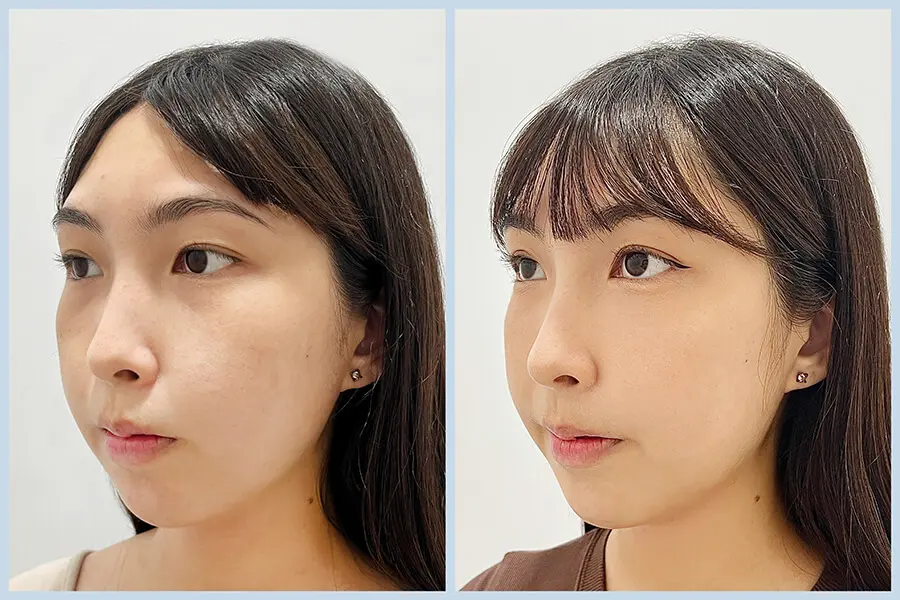 膠原流失型黑眼圈改善案例,透過膠原增生療程提升眼周支撐與明亮感