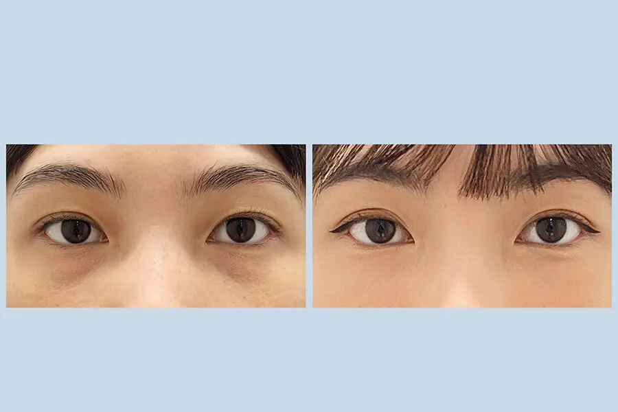 膠原流失型黑眼圈改善案例,透過膠原增生療程提升眼周支撐與明亮感