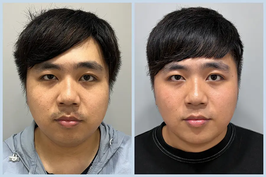 TP10_美音二代+除鬍