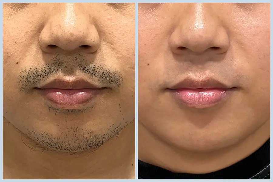 TP10_美音二代+除鬍 BA-07