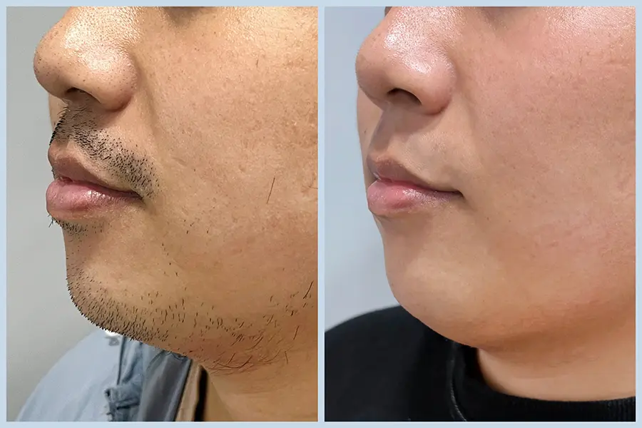 TP10_美音二代+除鬍 BA-08