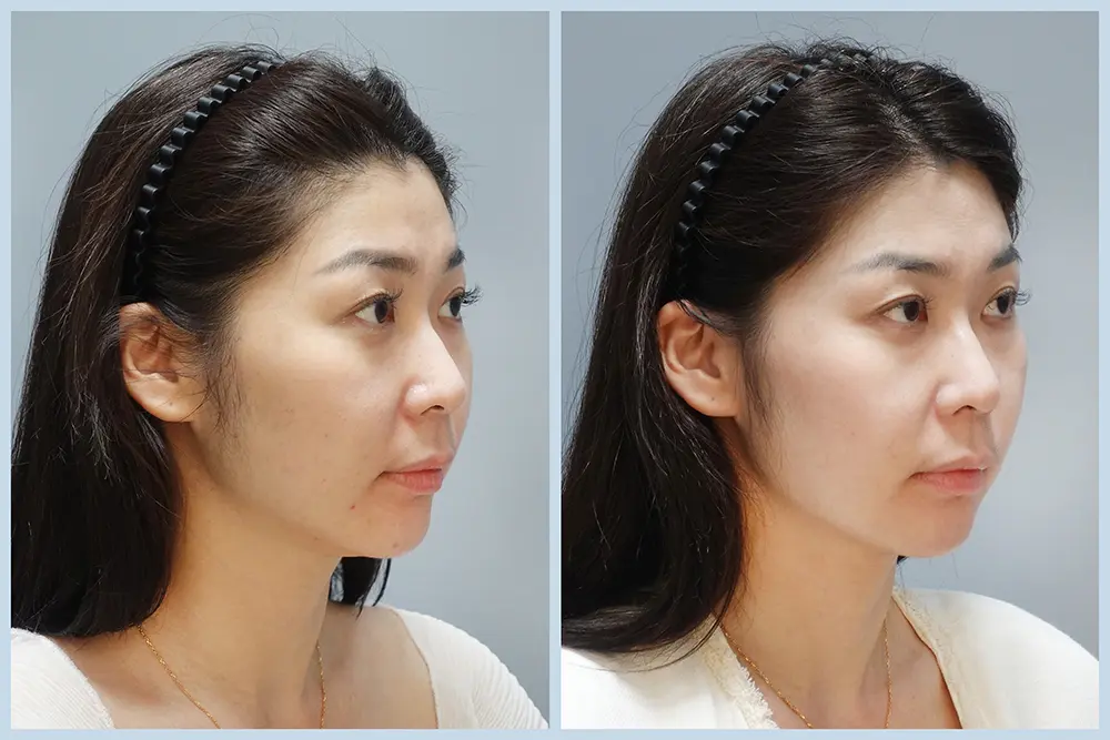 豐賦EP2-2_劉宛青_二代美國音波 BA-03