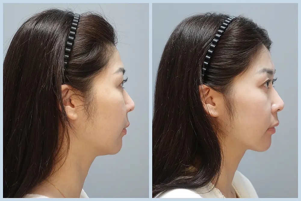 豐賦EP2-2_劉宛青_二代美國音波 BA-06