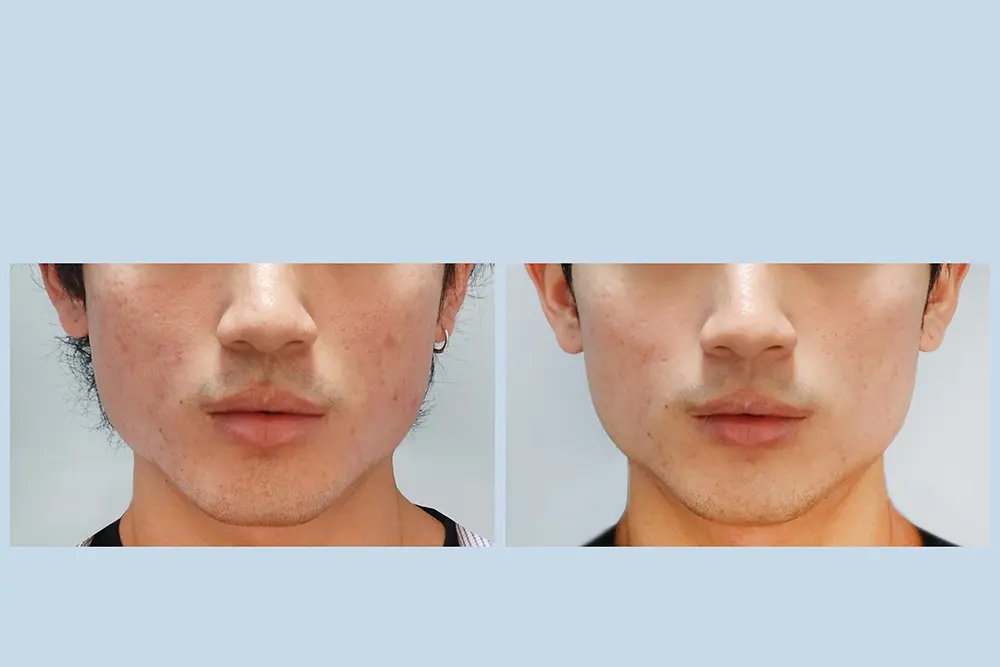 豐賦EP2-4_小棠_得美微針+喬雅露 BA-03