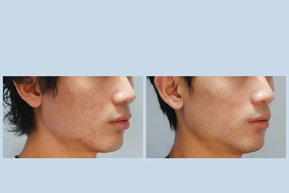 豐賦EP2-4_小棠_得美微針+喬雅露 BA-05