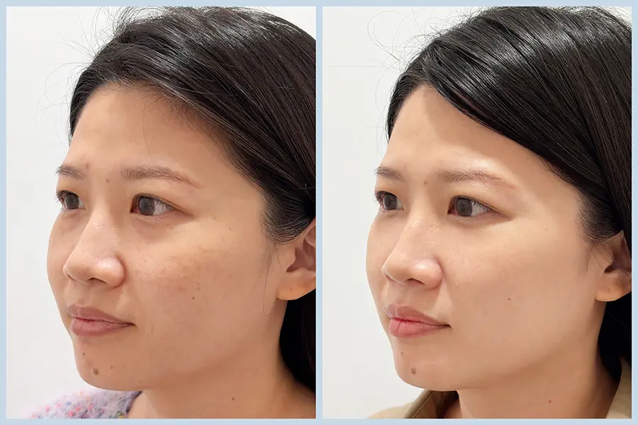 KH04_三效皮秒 案例 BA-首圖 (1)