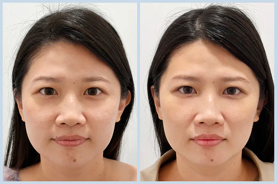 KH04_三效皮秒 案例 BA-首圖 (2)