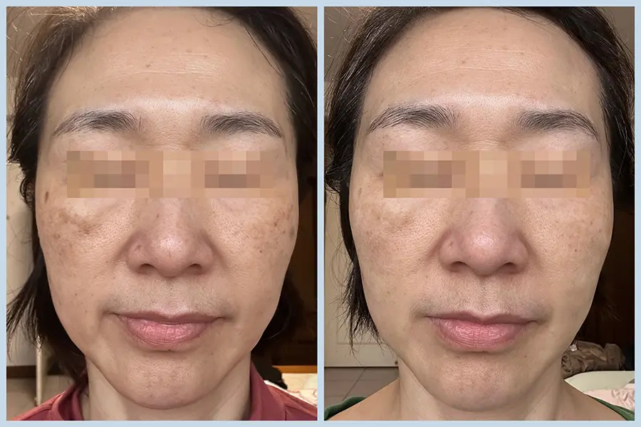 EP3-4_蜂巢皮秒+傳明酸注射 BA-02