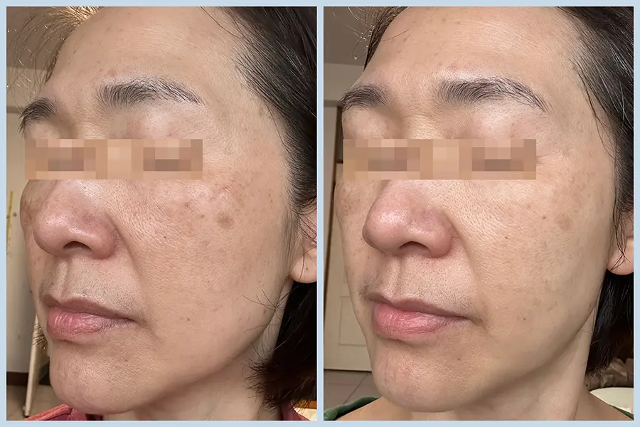 EP3-4__蜂巢皮秒+傳明酸注射 BA-04