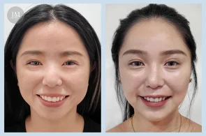 KH02_水光針+咀肌+魚尾紋BA-08