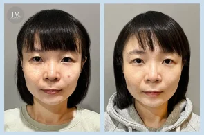 TC05_皮秒蜂巢BA-首圖