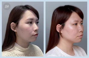 TC06_水光針BA-首圖