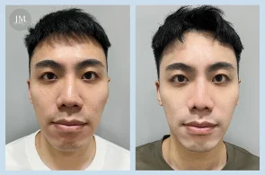 得美微針+麗珠蘭BA案例分享