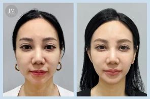 Ultherapy美國音波2.0案例分享 打造V臉線條