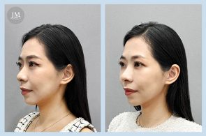 yiyi雙線音波咀肌