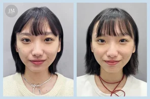 TY03_水光針BA-首圖