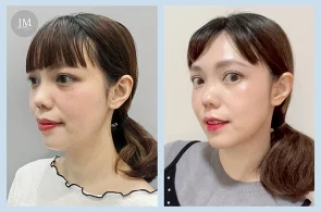 TY05_水光針BA-首圖