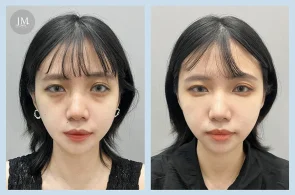 膠原蛋白針-黑眼圈