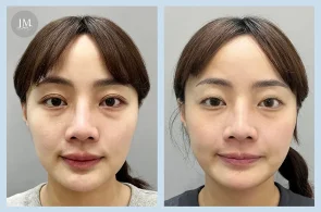 TY07_超玩美眼周電波 案例首圖