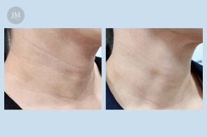 員工_喬雅露頸紋BA-首圖