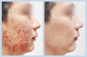 皮膚管理BA-痘痘肌-首圖