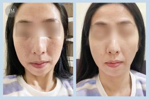 皮膚管理BA-皮秒-首圖