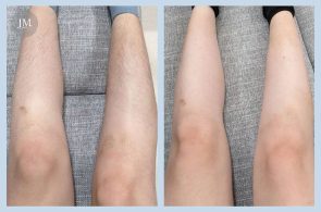 雷射除毛BA_153-Rita-首圖